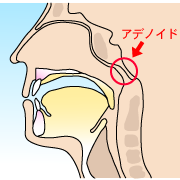 咽頭扁桃腺の異常